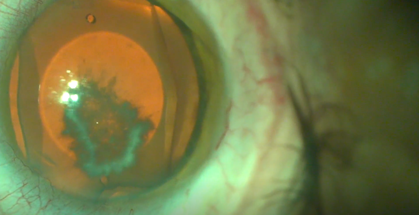 ICL Removal With Cataract Loose Lens Eyetube